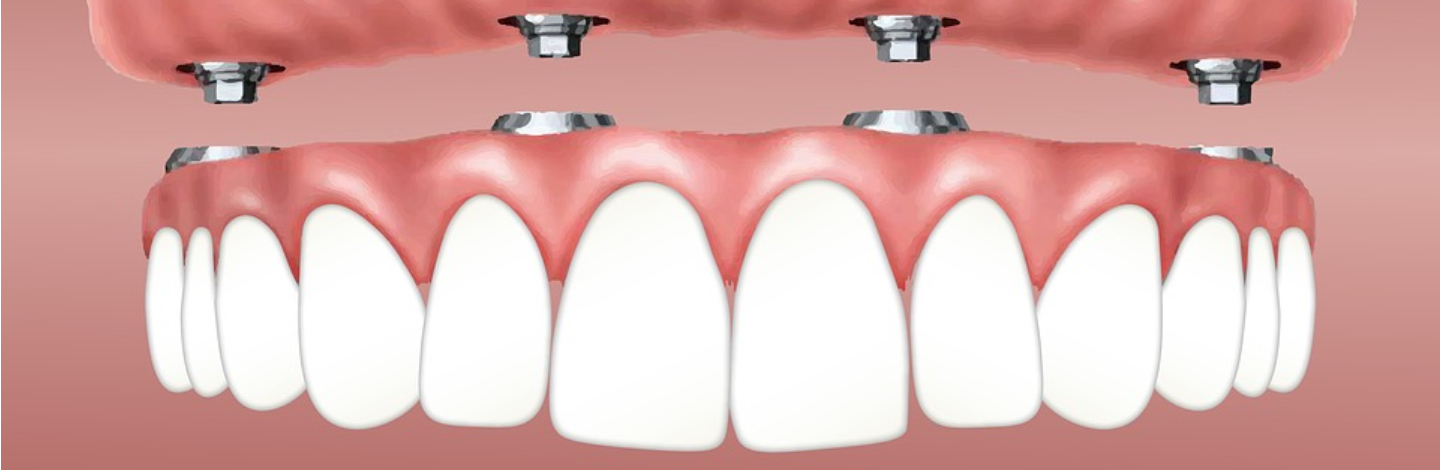 Perfect Teeth At Last With Affordable Dental Implants